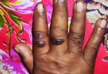 গাইবান্ধায় অসুস্থ গরু কাটাকাটি করা ১১ জনের দেহে ‘অ্যানথ্রাক্স উপসর্গ’