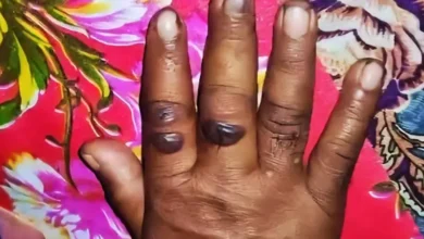 গাইবান্ধায় অসুস্থ গরু কাটাকাটি করা ১১ জনের দেহে ‘অ্যানথ্রাক্স উপসর্গ’