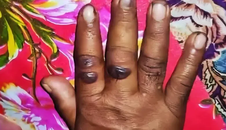 গাইবান্ধায় অসুস্থ গরু কাটাকাটি করা ১১ জনের দেহে ‘অ্যানথ্রাক্স উপসর্গ’